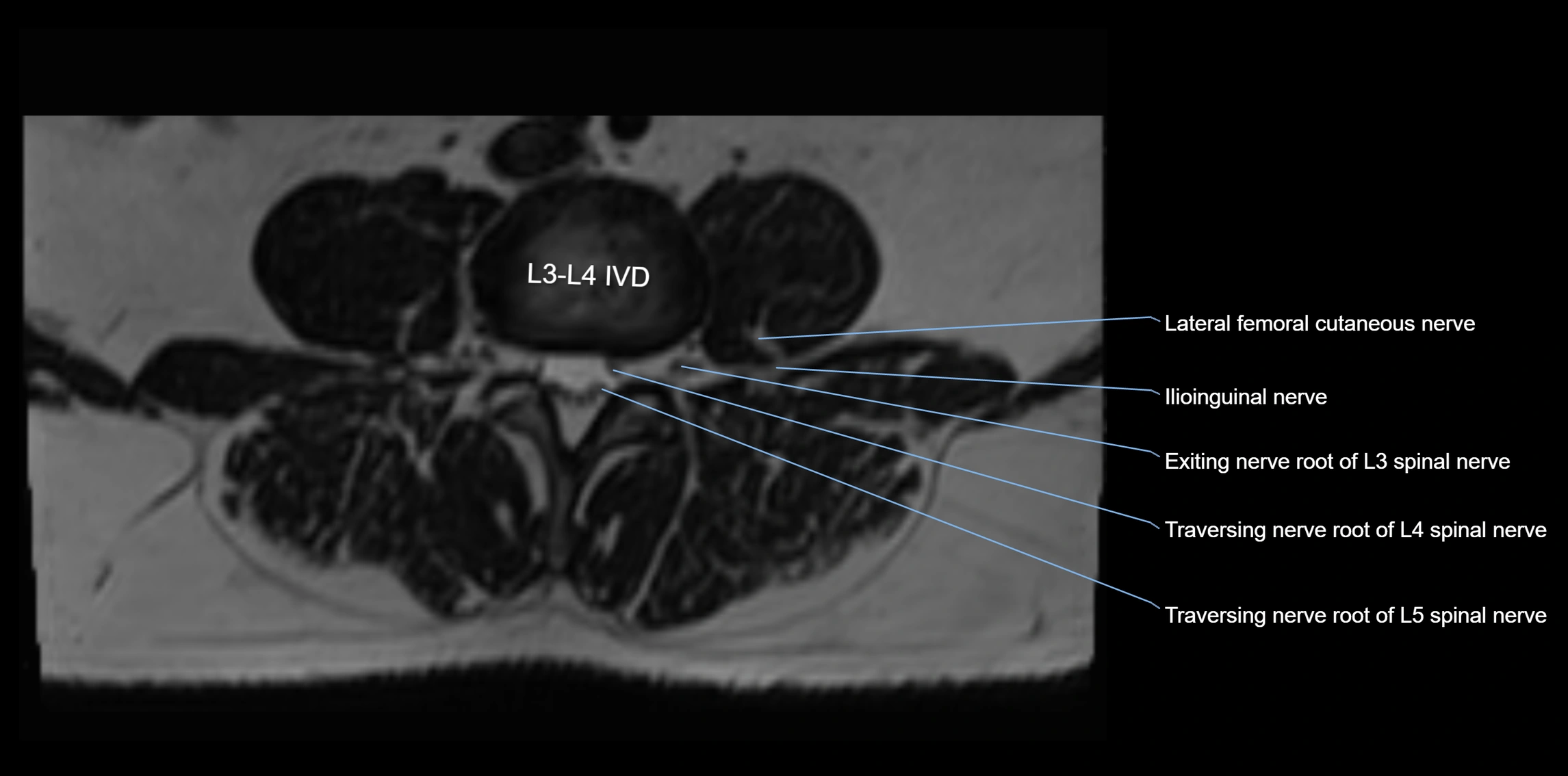 MR lumbosacral plexus axial cross sectional anatomy 3T  radiology  image-img-1008001-00029.webp